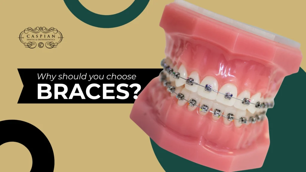 What Not to Eat with Braces and Why You Should Choose Them in Lauderdale Lakes, FL